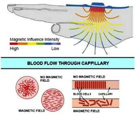 Shockwave Treatment in Milton