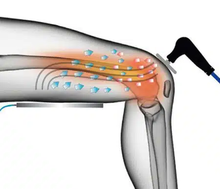 Shockwave Treatment in Milton